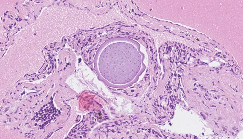 Histologisk vevssnitt av pylorusblindsekk fra pukkellaks med en enkel, dobbeltvegget sopplignende parasittstruktur (forenlig med Ichthyophonus sp.) i tarmveggen.