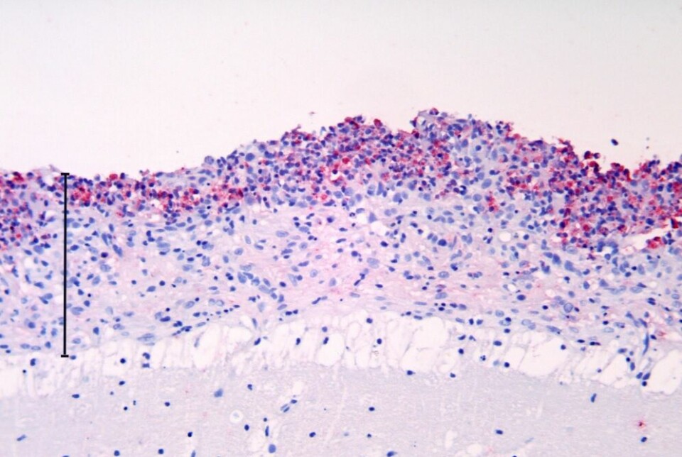 Laks med hjernehinnebetennelse (meningitt) forårsaket av Renibacterium salmonarium (rosa farging med immunhistokjemi)