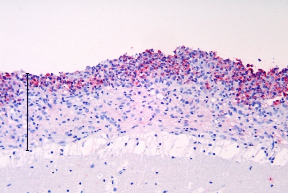 Laks med hjernehinnebetennelse (meningitt) forårsaket av Renibacterium salmonarium (rosa farging med immunhistokjemi) Laks med hjernehinnebetennelse (meningitt) forårsaket av Renibacterium salmonarium (rosa farging med immunhistokjemi)