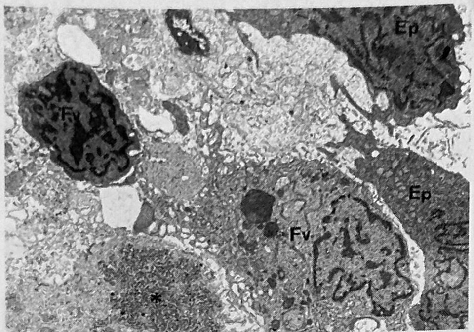 Figur D. Veggen i forkammeret hos laks med akutt CMS. Endotelceller (ep), forsvarsceller (Fv), «sjø» med virus-lignende partikler (stjerne). x2700