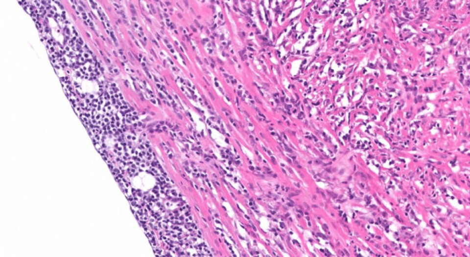 Spennende studie viser at vaksine har potensial til å redusere problemene med HSMB i fremtiden. Bildet viser typiske histologiske funn, bestående av betennelse i alle lag av hjertet. Her fra ventrikkel. Foto: PHARMAQ Analytiq